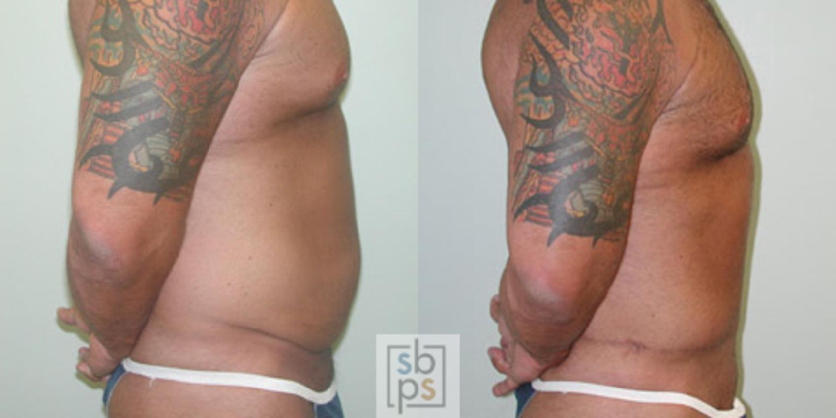 Before & After Tummy Tuck Case 17 View #3 View in Torrance & Los Angeles, CA, CA