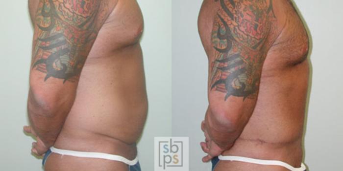 Before & After Liposuction Case 17 View #3 View in Torrance, CA