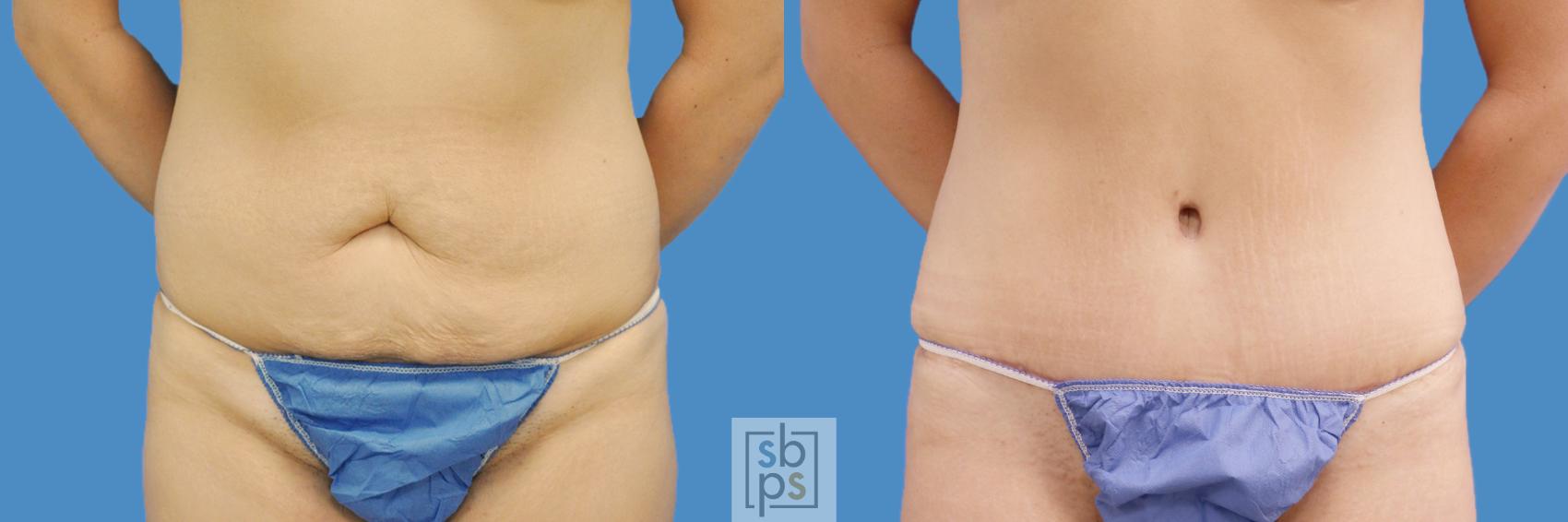 Before & After Liposuction Case 198 View #1 View in Torrance, CA
