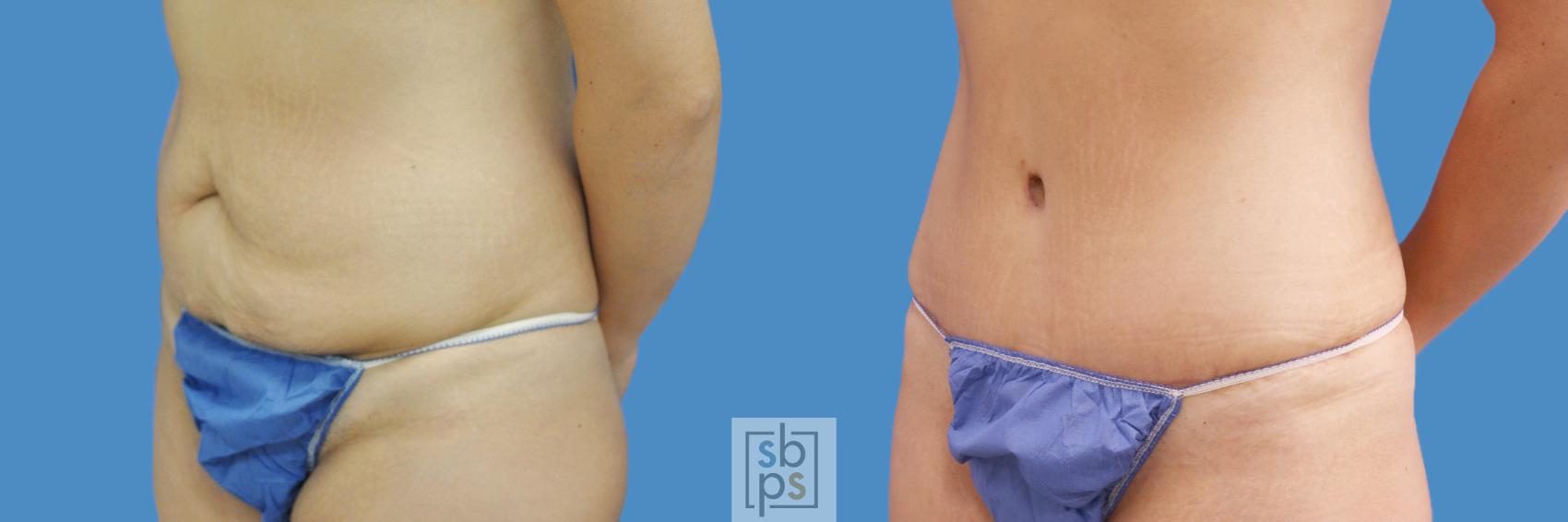 Before & After Liposuction Case 198 View #2 View in Torrance & Los Angeles, CA, CA