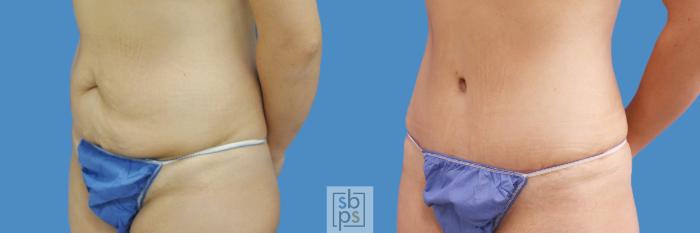Before & After Tummy Tuck Case 198 View #2 View in Torrance, CA