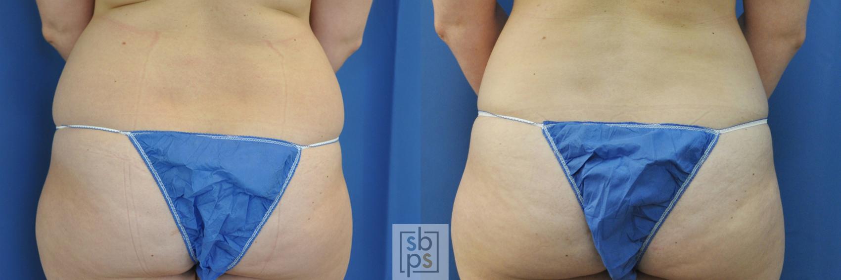 Before & After Liposuction Case 202 View #1 View in Torrance, CA