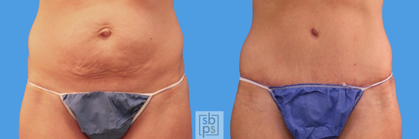 Before & After Liposuction Case 231 View #1 View in Torrance, CA