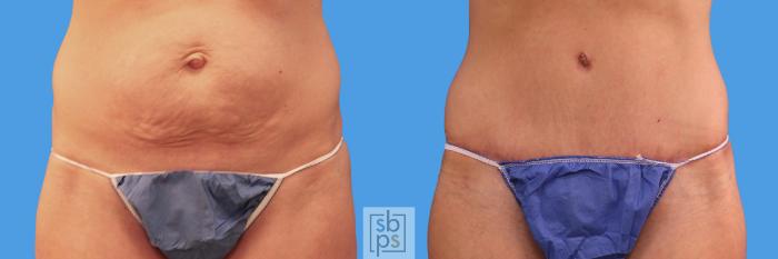 Before & After Tummy Tuck Case 231 View #1 View in Torrance, CA