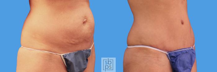 Before & After Tummy Tuck Case 231 View #2 View in Torrance, CA