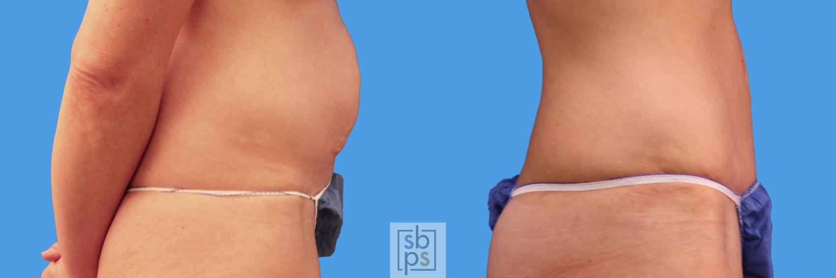 Before & After Liposuction Case 231 View #3 View in Torrance & Los Angeles, CA, CA