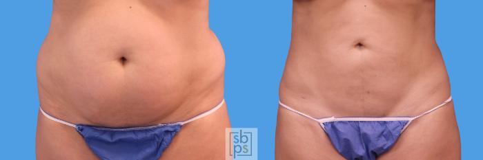 Before & After Liposuction Case 237 View #1 View in Torrance, CA