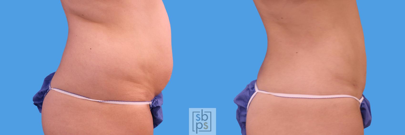 Before & After Liposuction Case 237 View #2 View in Los Angeles & Torrance, CA, CA