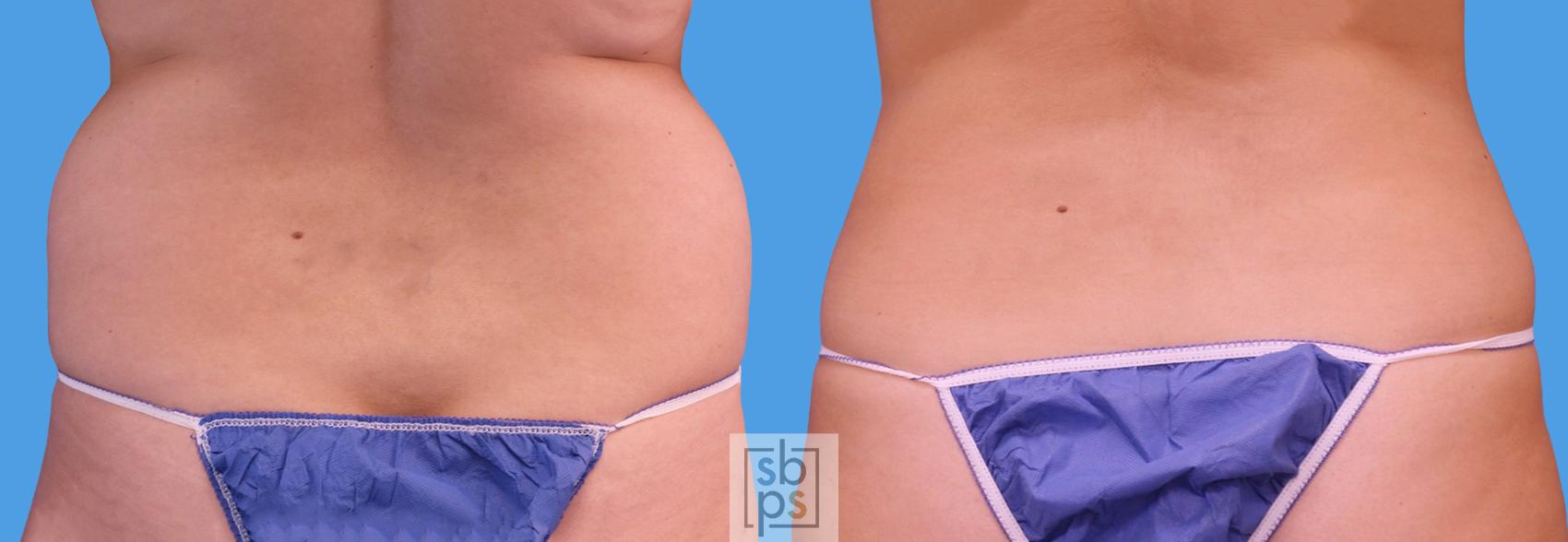 Before & After Liposuction Case 237 View #3 View in Los Angeles, Torrance & Long Beach, CA