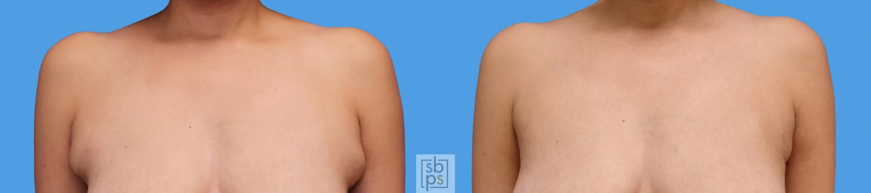Before & After Liposuction Case 239 View #1 View in Torrance, CA