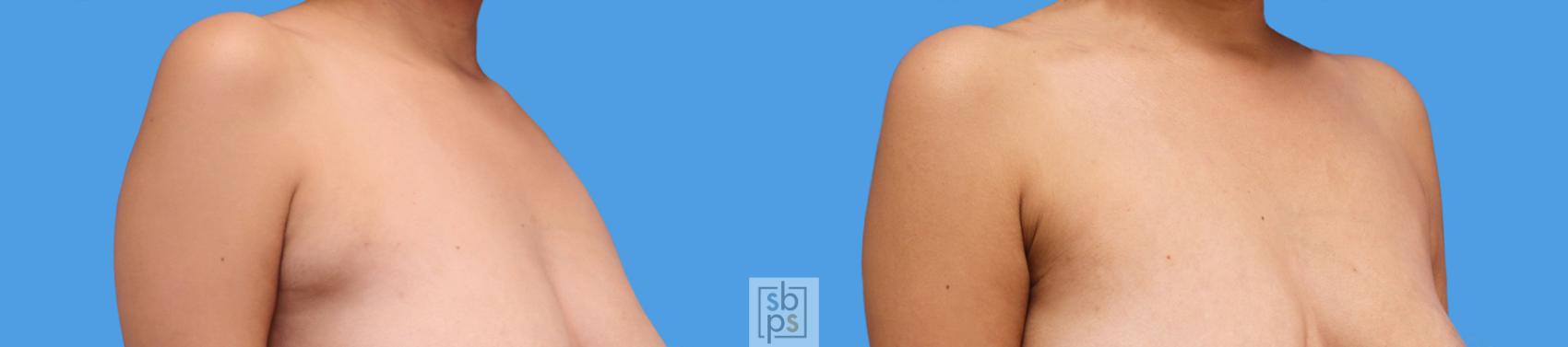 Before & After Liposuction Case 239 View #2 View in Torrance & Los Angeles, CA, CA