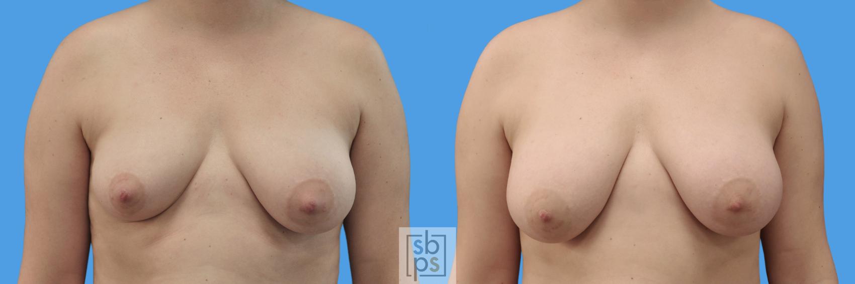 Before & After Liposuction Case 245 View #1 View in Torrance, CA