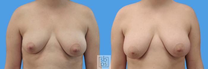 Before & After Fat Injection Case 245 View #1 View in Torrance, CA