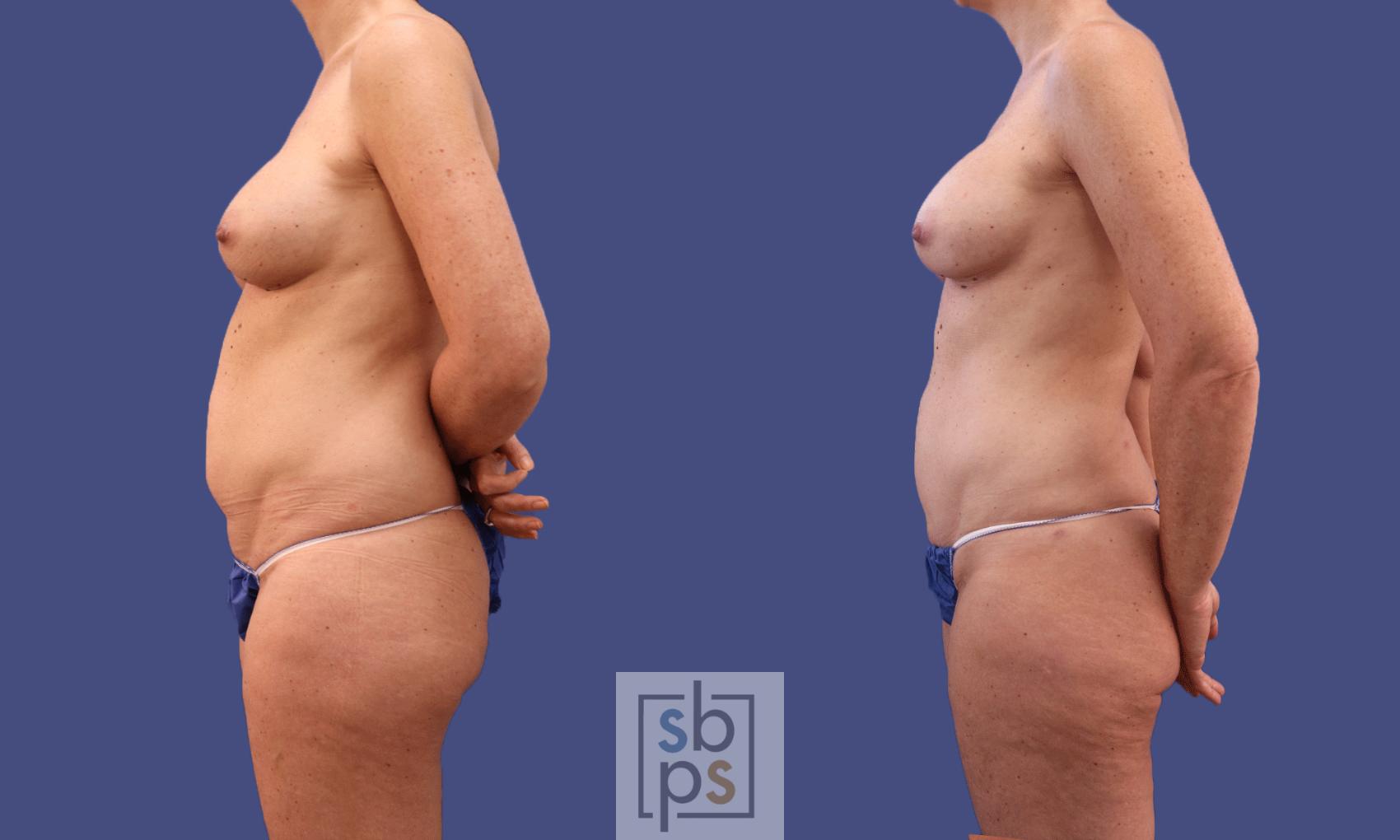 Before & After Breast Augmentation Case 297 View #1 View in Torrance, CA