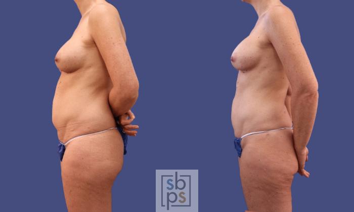 Before & After Liposuction Case 297 View #1 View in Torrance, CA