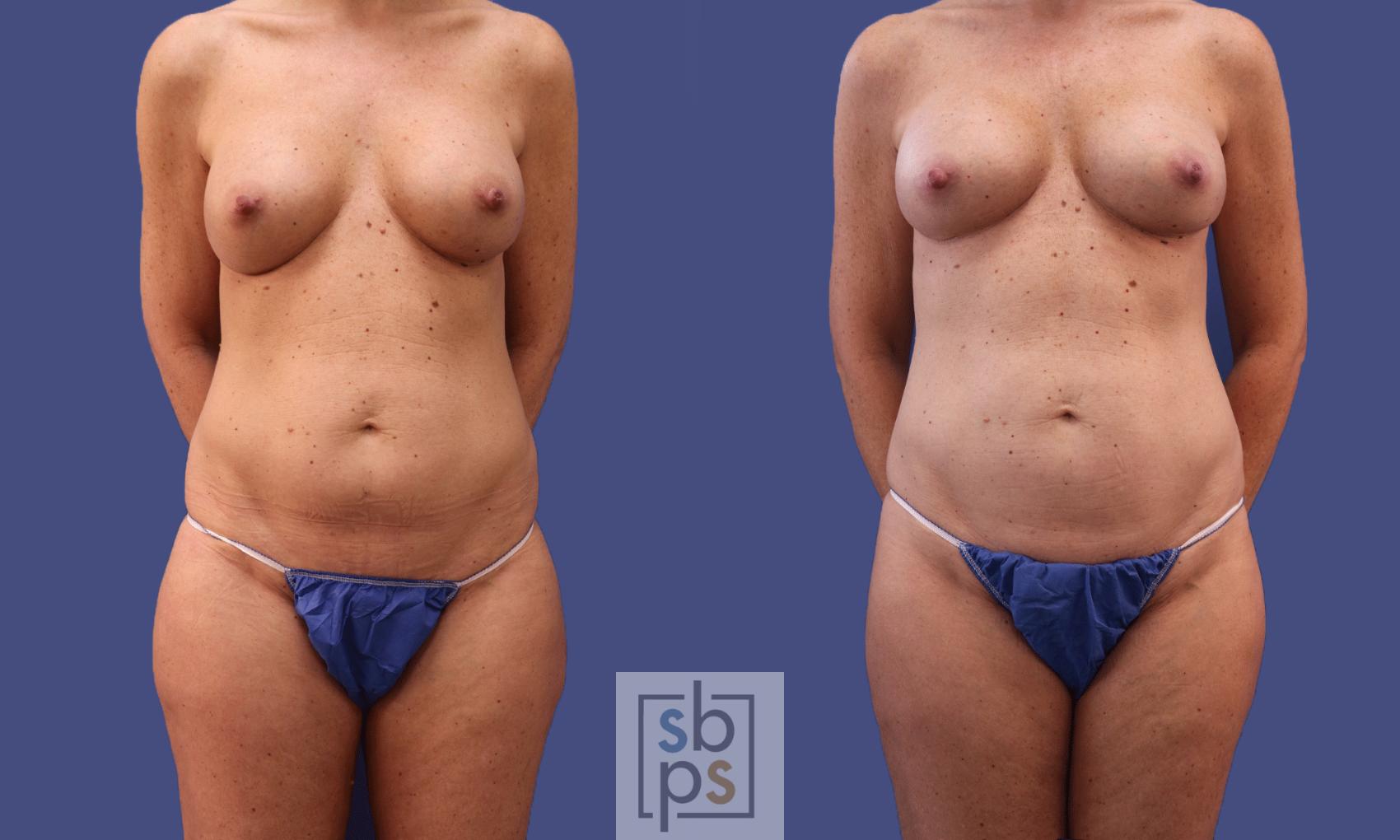 Before & After Liposuction Case 297 View #2 View in Torrance & Los Angeles, CA, CA