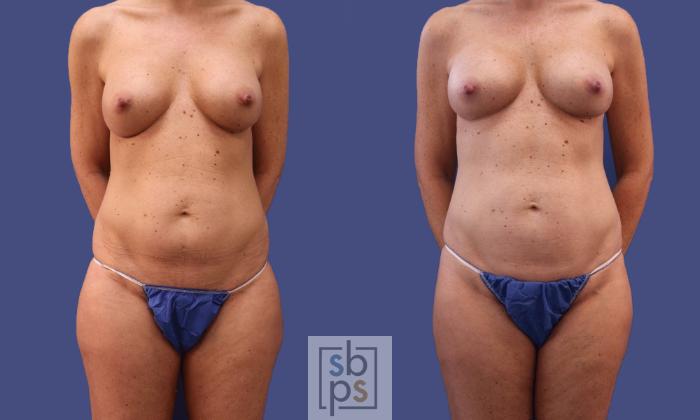 Before & After Breast Augmentation Case 297 View #2 View in Torrance, CA