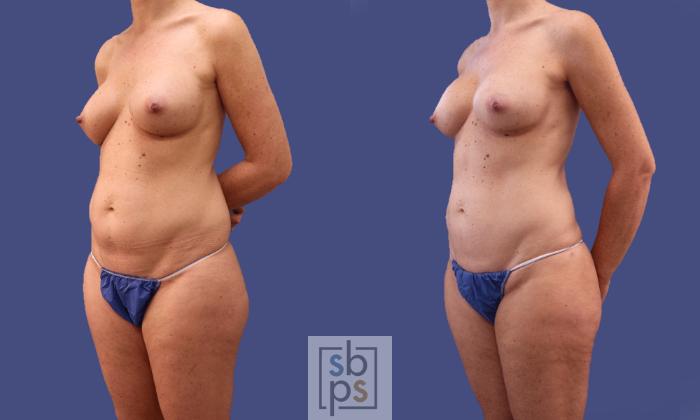Before & After Liposuction Case 297 View #3 View in Torrance, CA