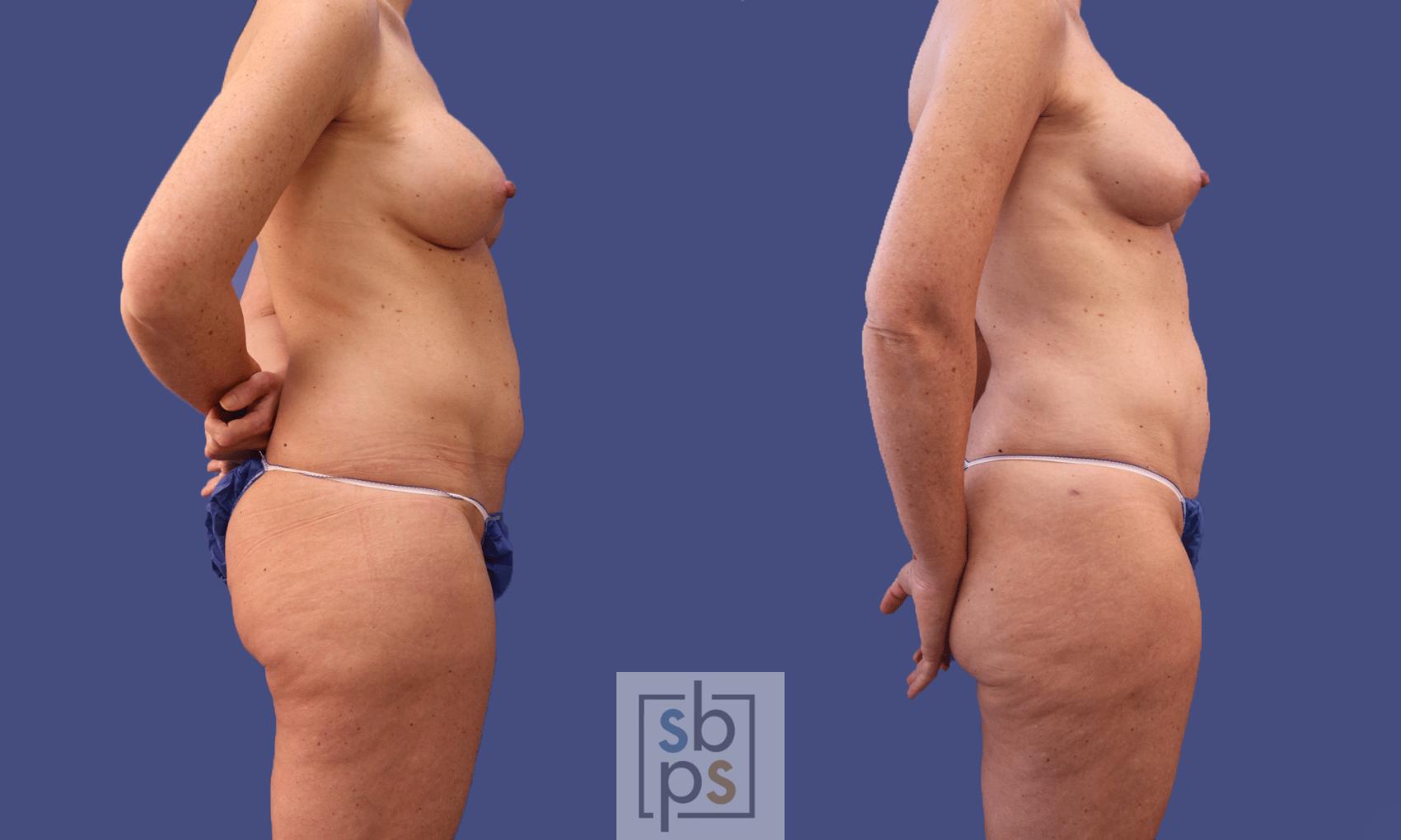 Before & After Liposuction Case 297 View #4 View in Torrance & Los Angeles, CA, CA