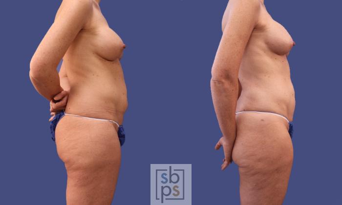 Before & After Liposuction Case 297 View #4 View in Torrance, CA