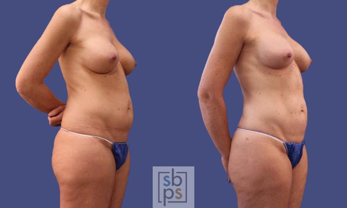 Before & After Liposuction Case 297 View #5 View in Torrance, CA