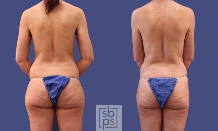 Before & After Liposuction Case 297 View #6 View in Torrance, CA