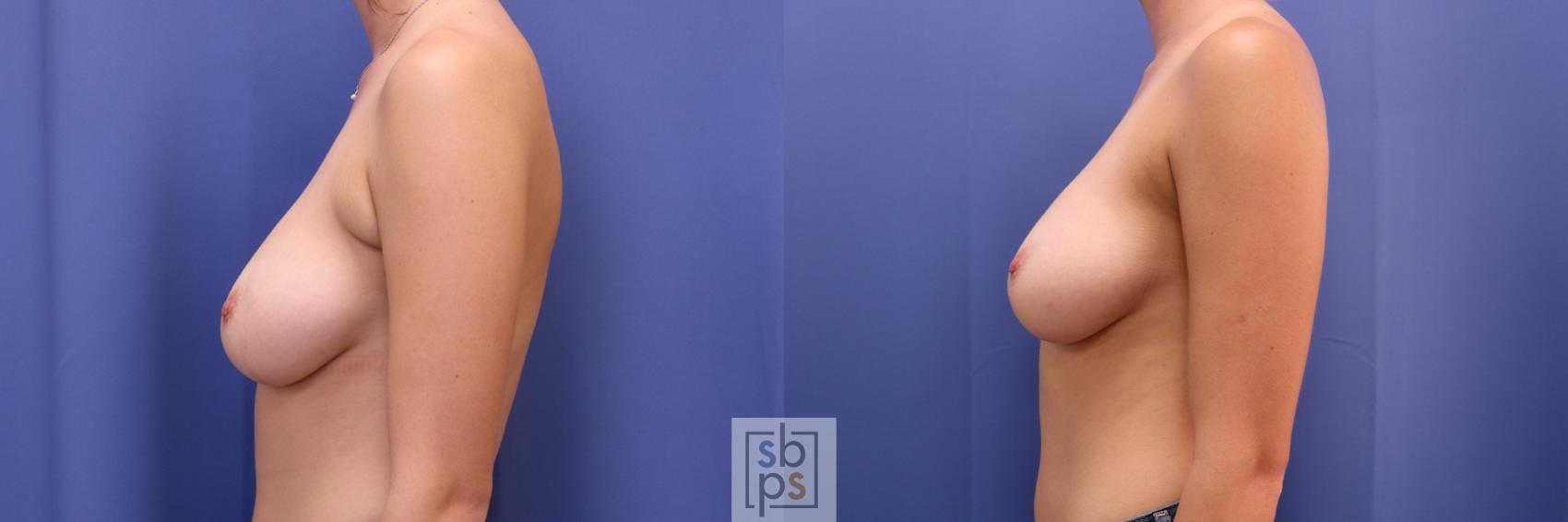 Before & After Liposuction Case 307 View #2 View in Torrance & Los Angeles, CA, CA