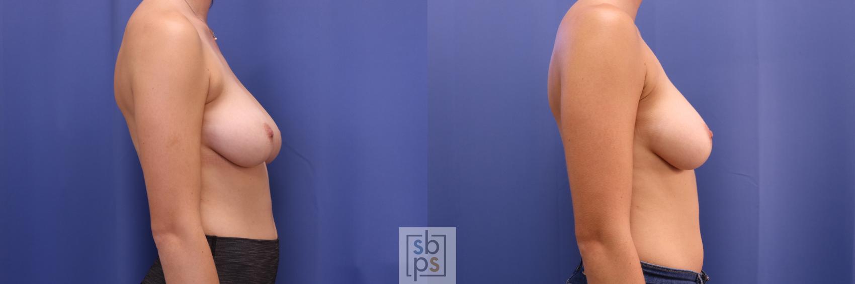 Before & After Liposuction Case 307 View #4 View in Torrance & Los Angeles, CA, CA