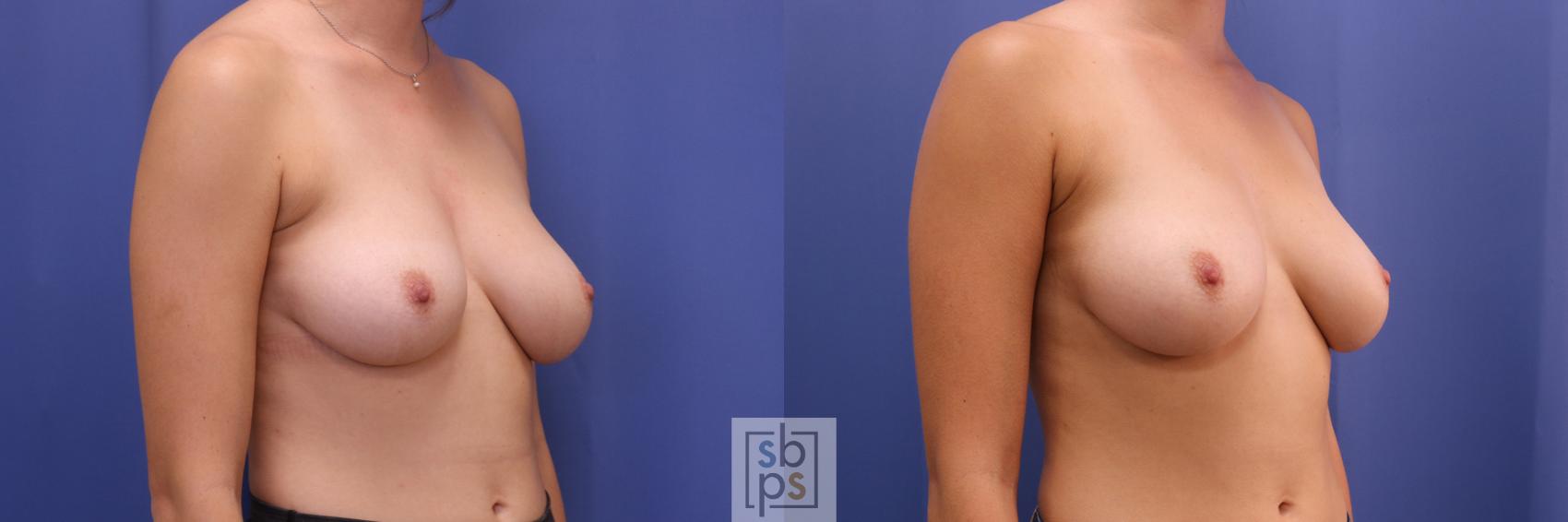 Before & After Liposuction Case 307 View #5 View in Torrance & Los Angeles, CA, CA