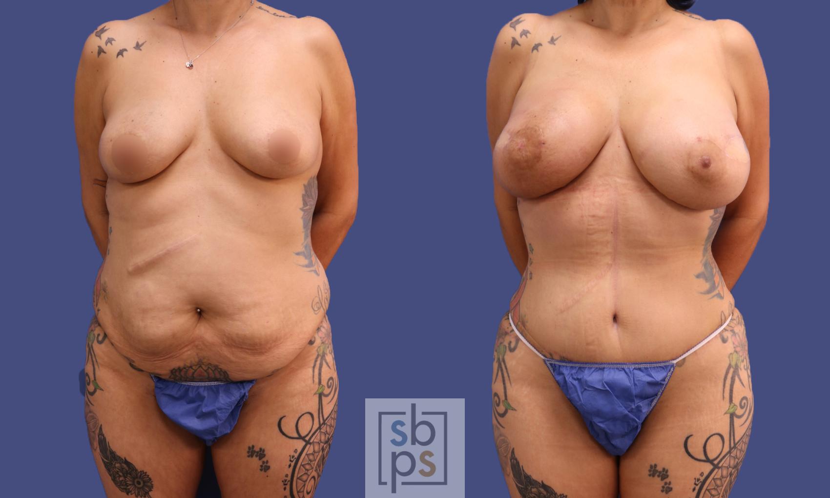 Before & After Liposuction Case 319 View #1 View in Torrance, CA