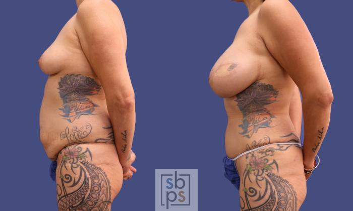 Before & After Liposuction Case 319 View #2 View in Torrance, CA