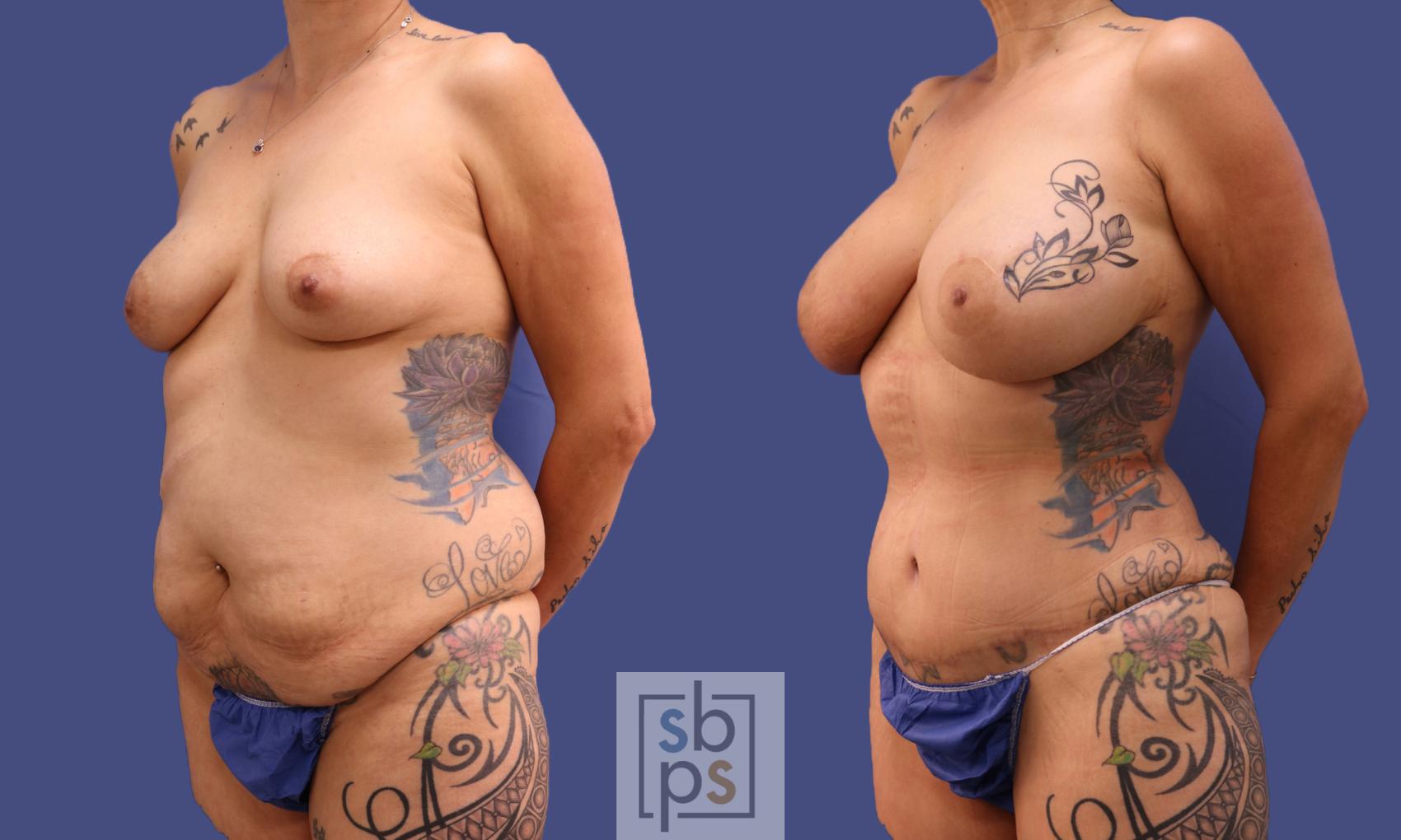 Before & After Liposuction Case 319 View #3 View in Torrance & Los Angeles, CA, CA