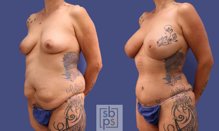 Before & After Liposuction Case 319 View #3 View in Torrance, CA
