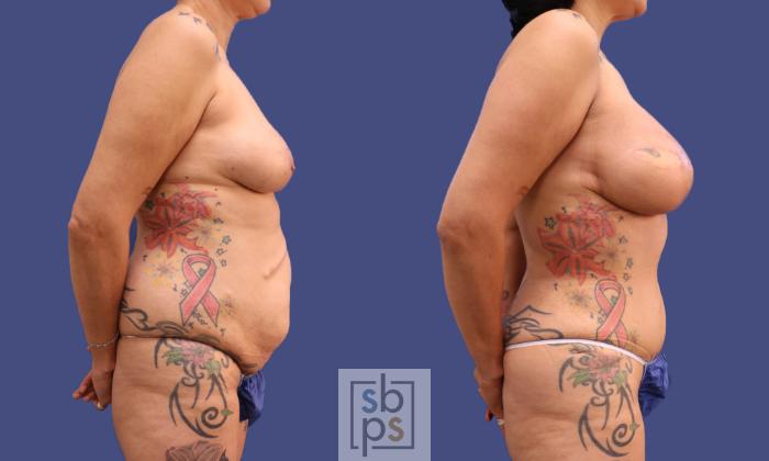 Before & After Breast Augmentation Case 319 View #4 View in Torrance, CA