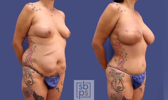Before & After Liposuction Case 319 View #5 View in Torrance, CA