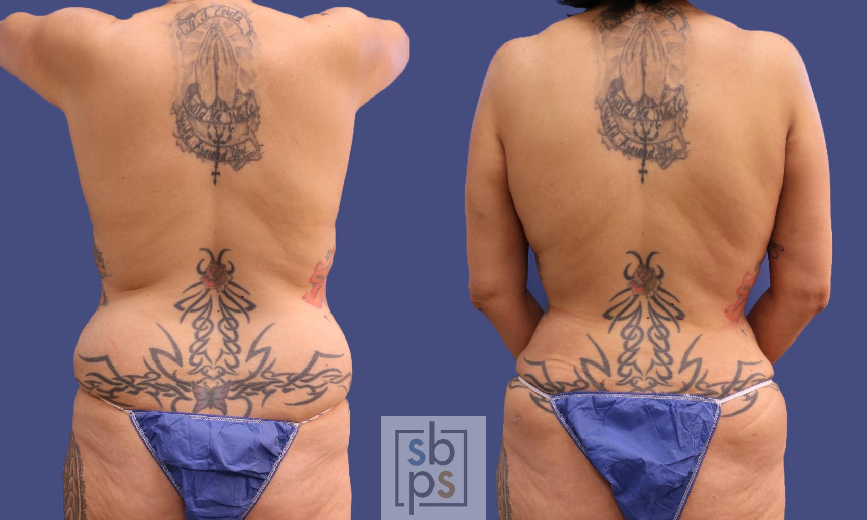 Before & After Liposuction Case 319 View #6 View in Torrance & Los Angeles, CA, CA
