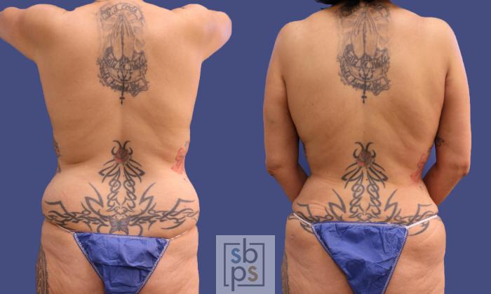 Before & After Liposuction Case 319 View #6 View in Torrance, CA