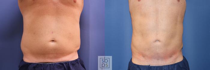 Before & After Liposuction Case 346 View #1 View in Torrance, CA