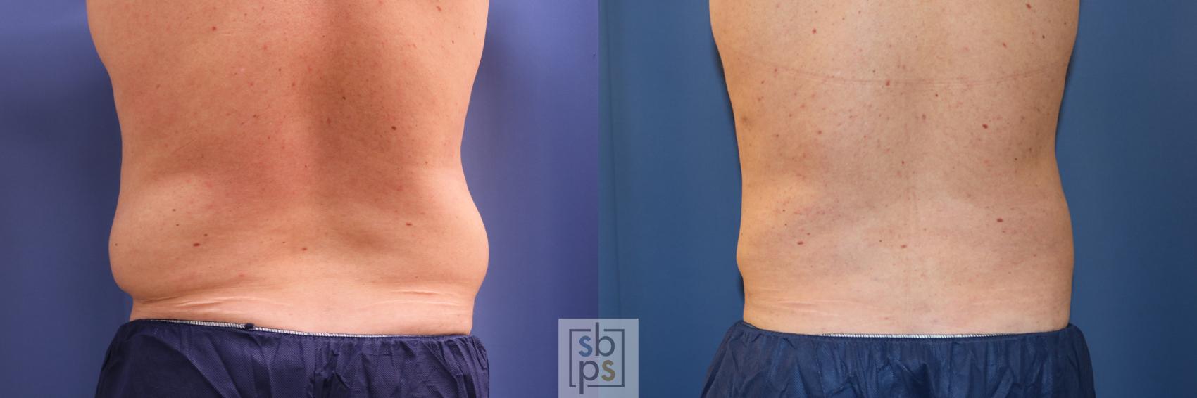 Before & After Liposuction Case 346 View #2 View in Torrance, CA