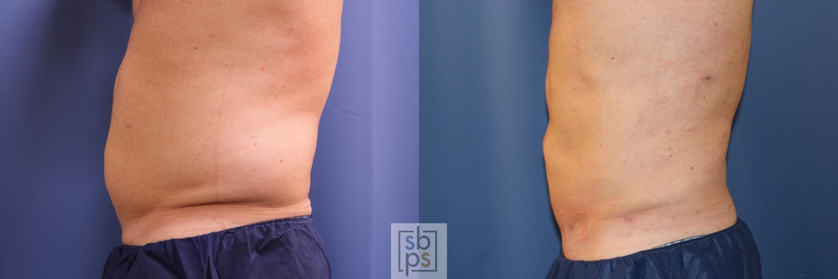 Before & After Liposuction Case 346 View #3 View in Torrance, CA