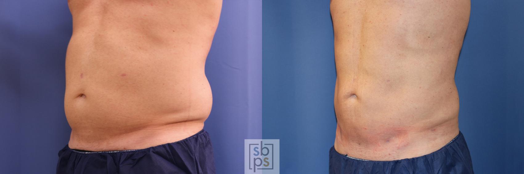 Before & After Liposuction Case 346 View #4 View in Torrance, CA