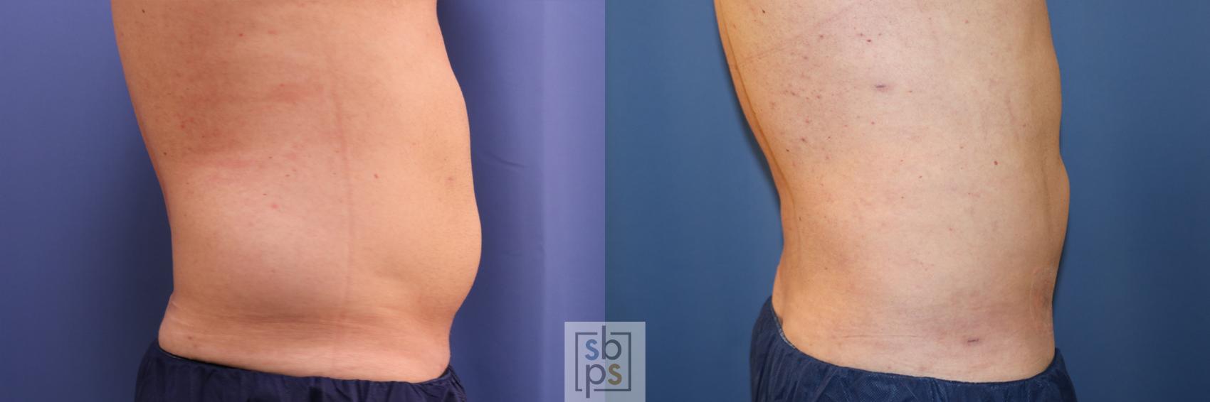 Before & After Liposuction Case 346 View #5 View in Torrance, CA