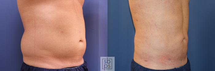 Before & After Liposuction Case 346 View #6 View in Torrance, CA