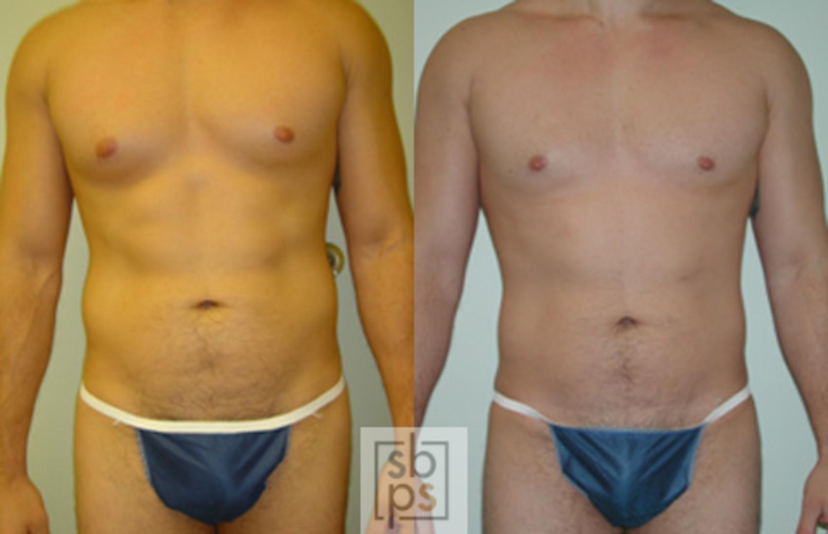 Before & After Liposuction Case 38 View #1 View in Torrance, CA