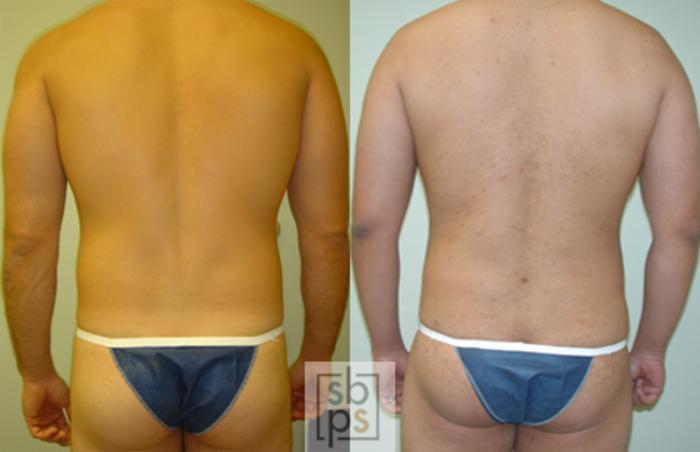 Before & After Liposuction Case 38 View #2 View in Torrance, CA