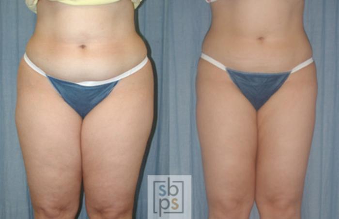 Before & After Liposuction Case 39 View #1 View in Torrance, CA