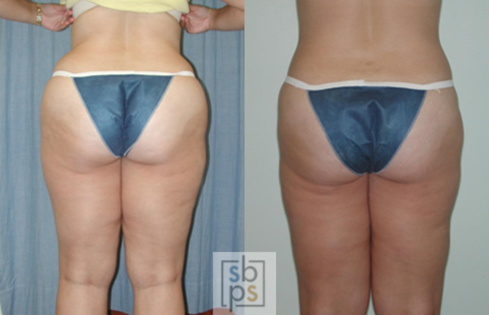 Before & After Liposuction Case 39 View #2 View in Torrance & Los Angeles, CA, CA