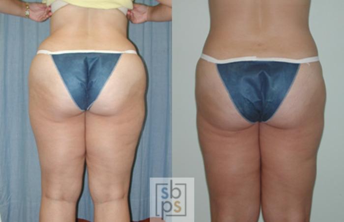 Before & After Liposuction Case 39 View #2 View in Torrance, CA