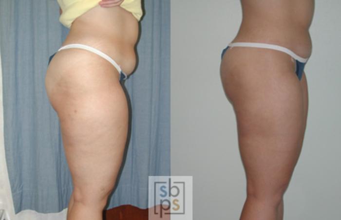 Before & After Liposuction Case 39 View #3 View in Torrance, CA