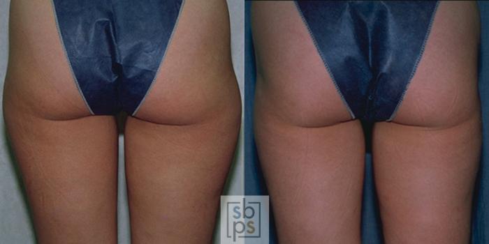 Before & After Liposuction Case 46 View #1 View in Torrance, CA